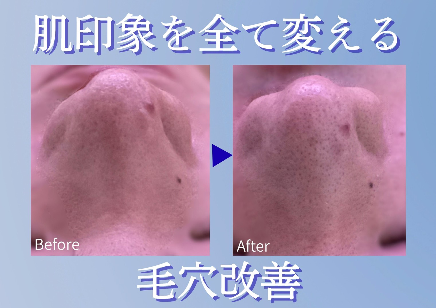 毛穴の黒ずみ改善 施術前後