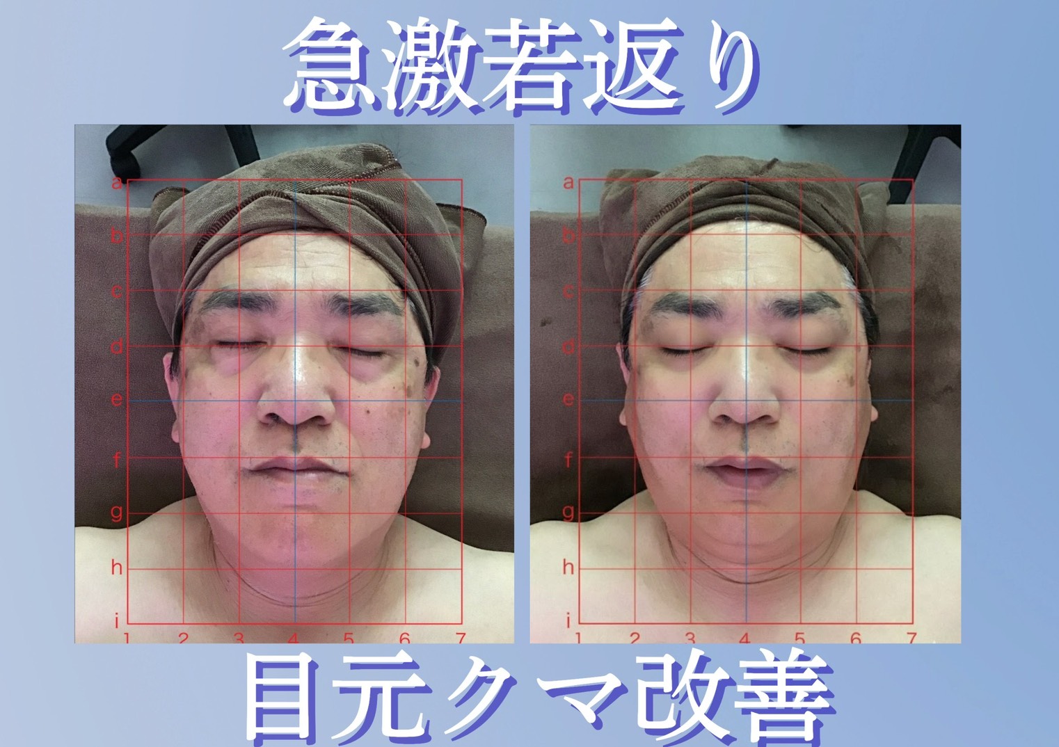 シミの改善 施術前後